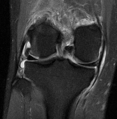Figure 4 for case Patellar dislocation
